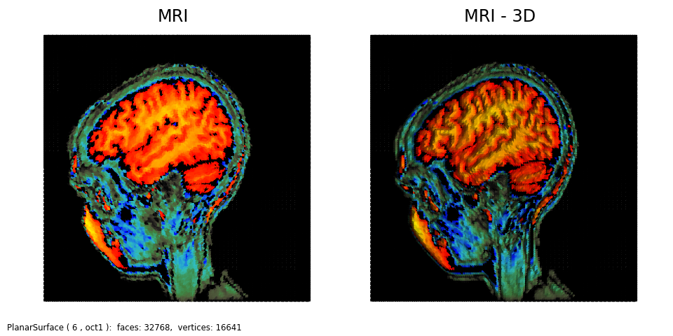 picdemo_MRI_Regions